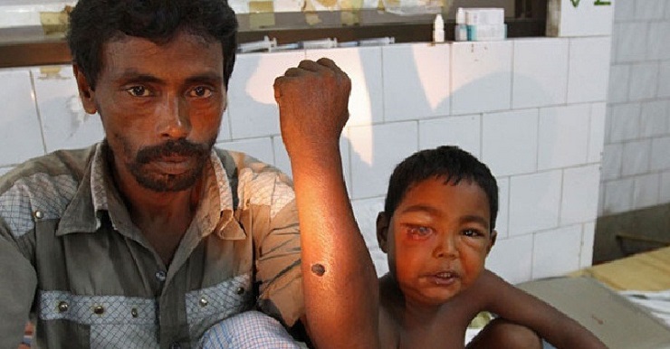 ডেঙ্গুর পর এবার নতুন আতঙ্ক অ্যানথ্রাক্স