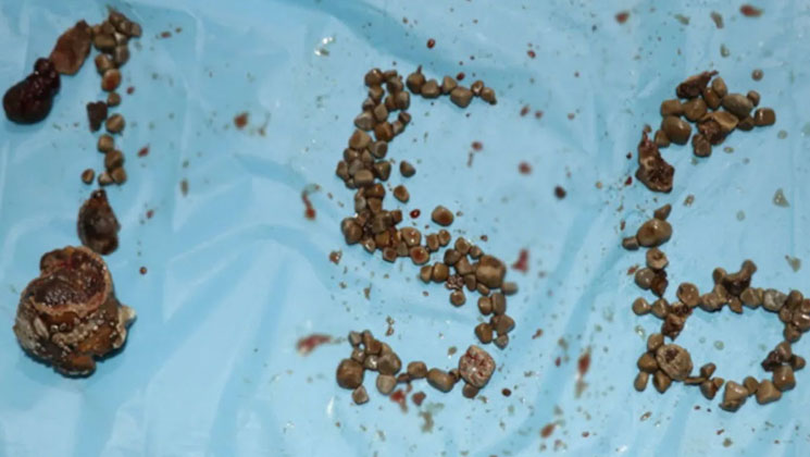 অপারেশন ছাড়াই কিডনি থেকে ১৫৬টি পাথর বের করল
