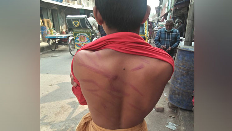 শিহাবের সারা পিঠে মাদ্রাসা সুপারের বেত্রাঘাতের জখম