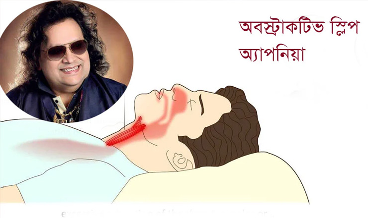 অবস্ট্রাকটিভ স্লিপ অ্যাপনিয়া রোগেই মৃত্যু বাপ্পি লাহিড়ির, জেনে নিন এই রোগ সম্পর্কে