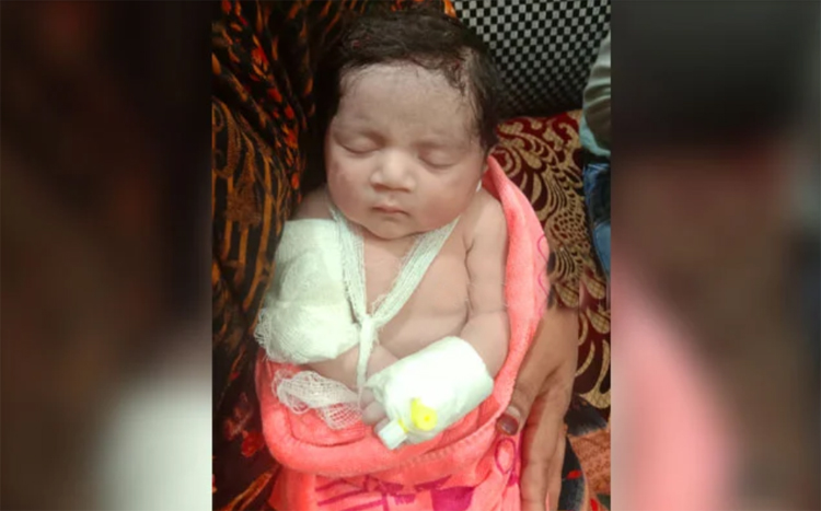 সেই মিরাকল শিশুটির হাতের হাড় ভেঙে গেছে