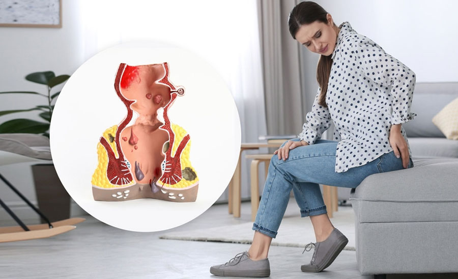 যে ৫ কারণে আপনার পাইলস হতে পারে