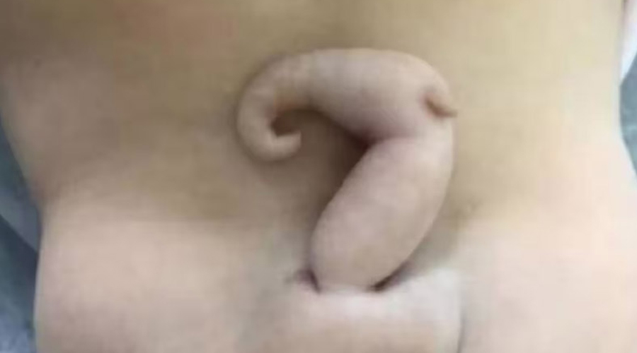 ৬ সেন্টিমিটার লেজ নিয়ে শিশুর জন্ম