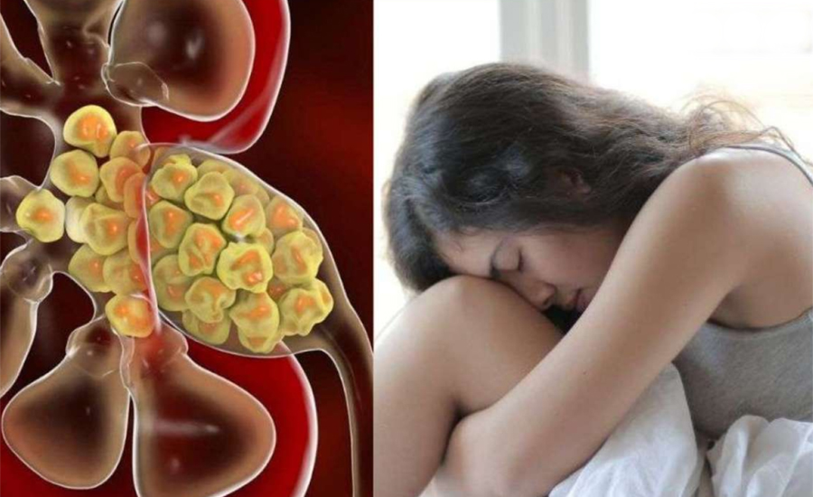 কোন ৫ খাবার খেলে কিডনিতে পাথর জমার আশঙ্কা বাড়ে?